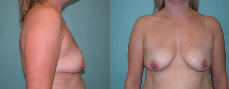 before breast augmentation 