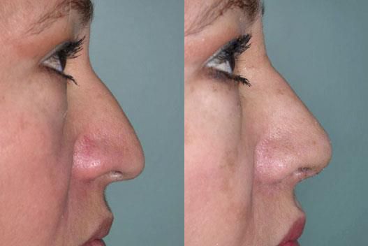 before and after nose surgery