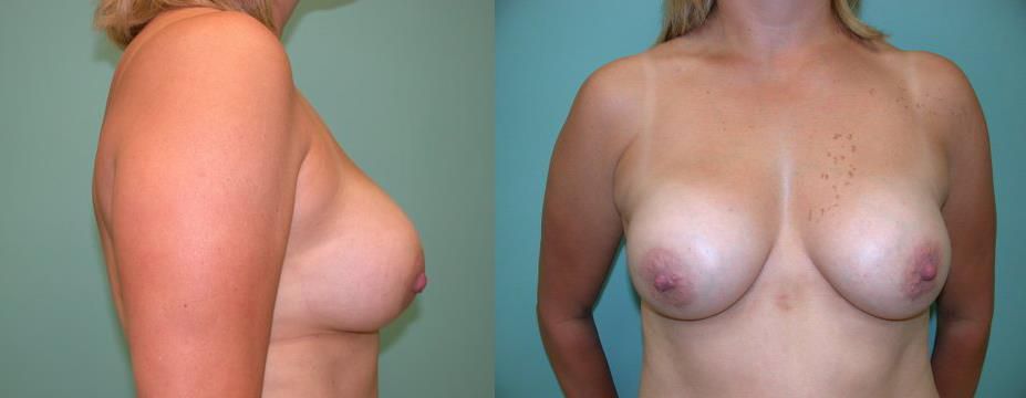 after breast augmentation 