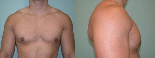 after male breast reduction