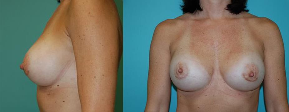 after breast augmentation 
