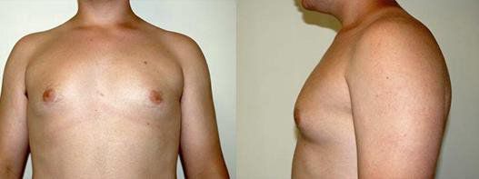 before male breast reduction