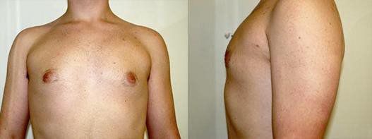 after male breast reduction