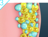 coolsculpting explanation graphic 3