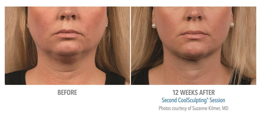 before and twelve weeks after coolsculpting session