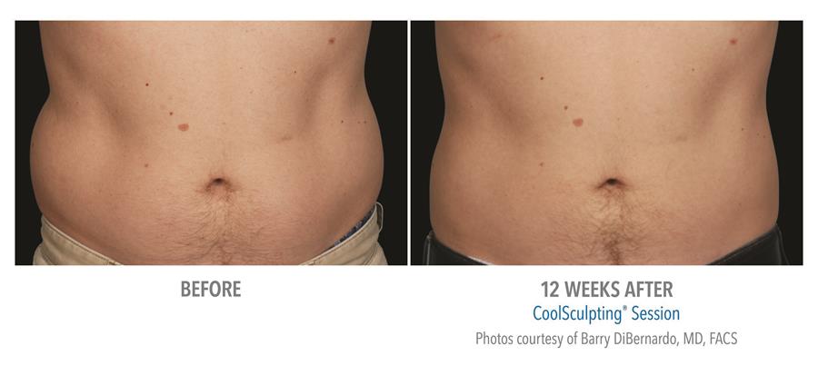 before and twelve weeks after coolsculpting session