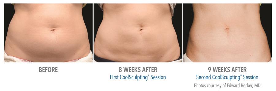 before and after first and second coolsculpting session