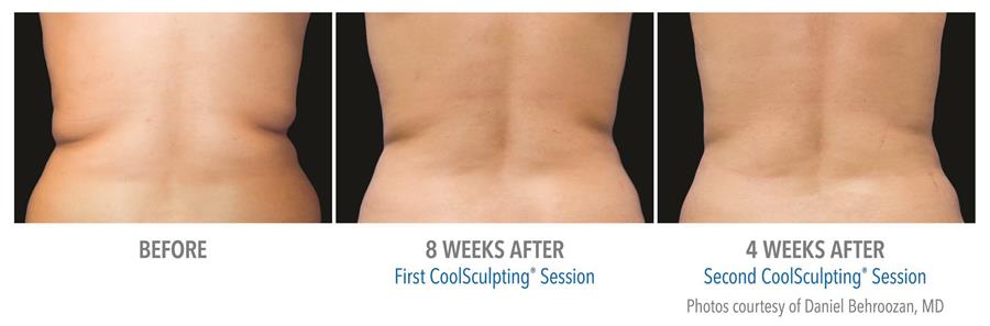 before and after first two coolsculpting sesions