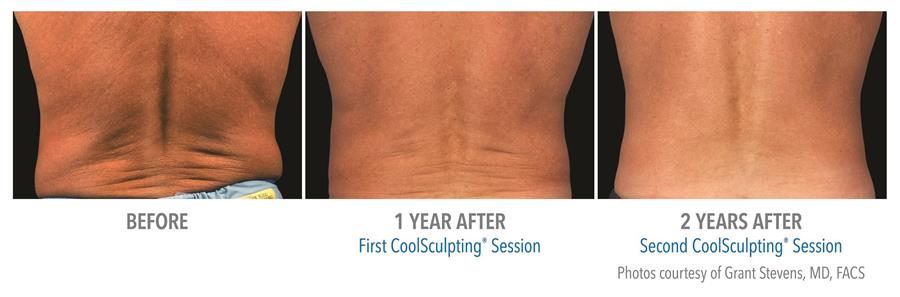 before and after first two coolsculpting sessions