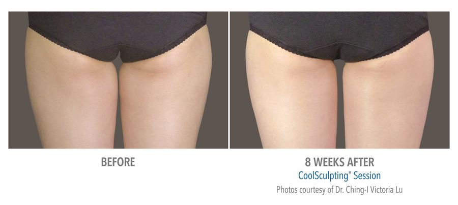 before and eight weeks after coolsculpting session