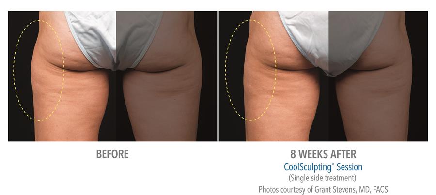 before and eight weeks after coolsculpting session